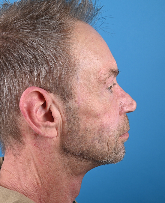 right side view after blepharoplasty by dr. patel