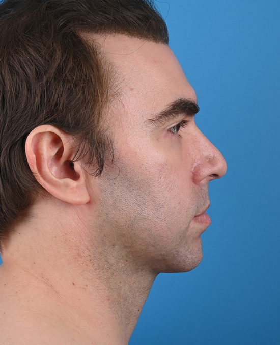 right side view after genioplasty & blepharoplasty
