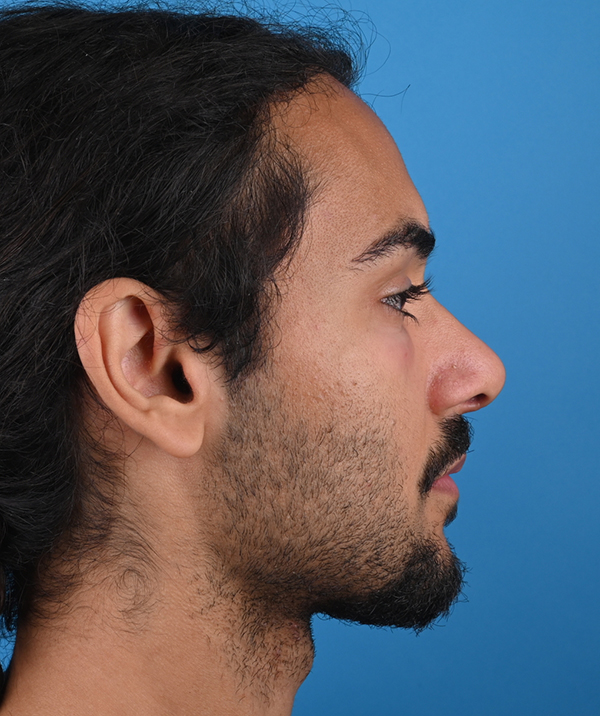 right side view after rhinoplasty