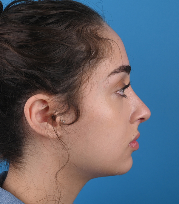 right side view after rhinoplasty by dr. patel
