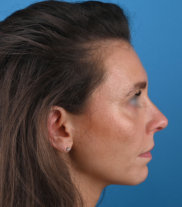 right side view after rhinoplasty by dr. patel
