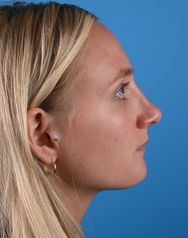 right side view after rhinoplasty by dr. patel