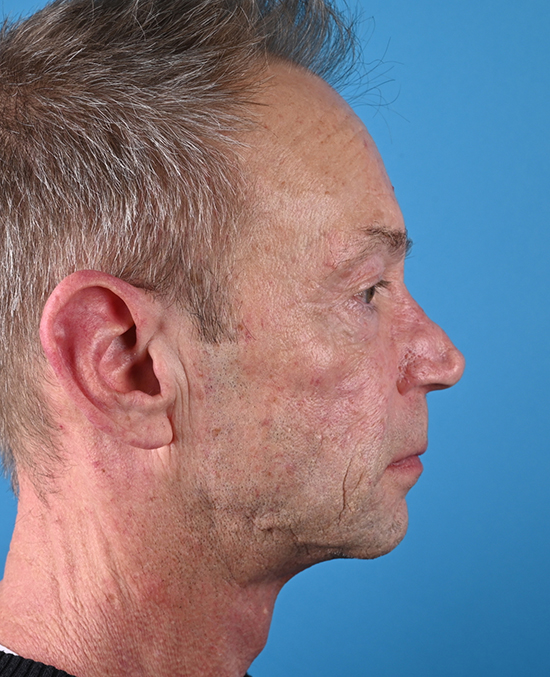 right side view before blepharoplasty by dr. patel