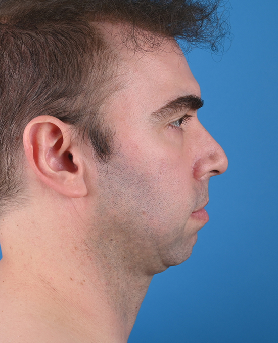 right side view bedore genioplasty & blepharoplasty