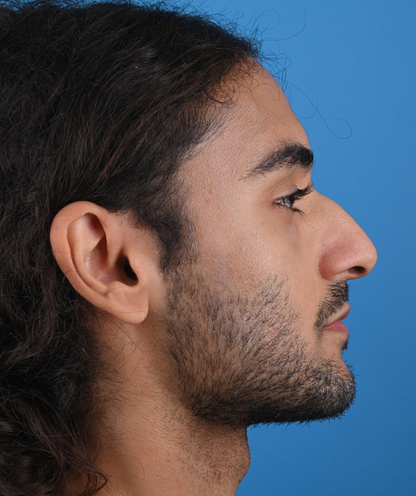right side view before rhinoplasty