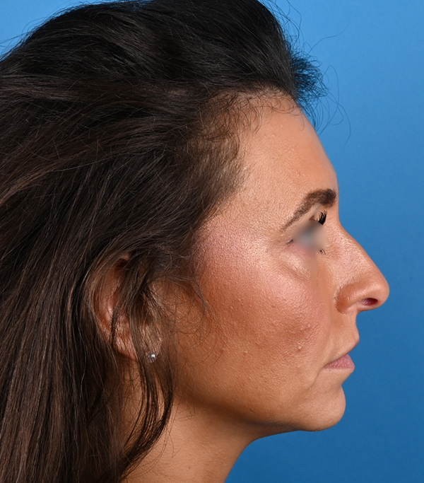 right side view before rhinoplasty by dr. patel