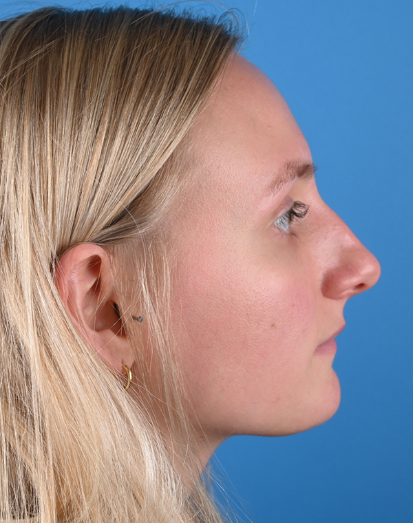 right side view before rhinoplasty by dr. patel