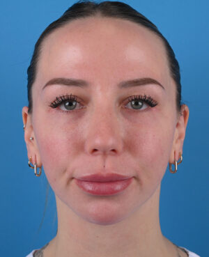 front view after blepharoplasty