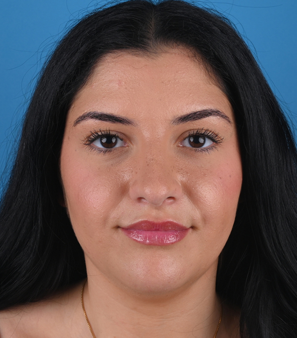 front view after rhinoplasty and genioplasty