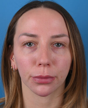 front view before blepharoplasty