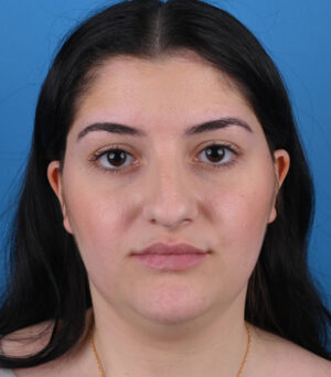 front view before rhinoplasty and genioplasty front view before rhinoplasty and genioplasty