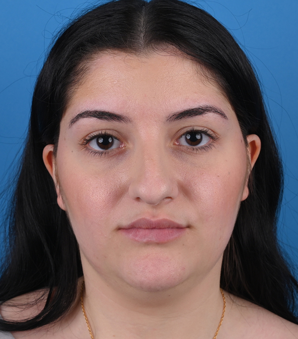front view before rhinoplasty and genioplasty