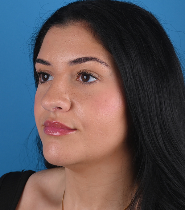 left oblique view after rhinoplasty and genioplasty