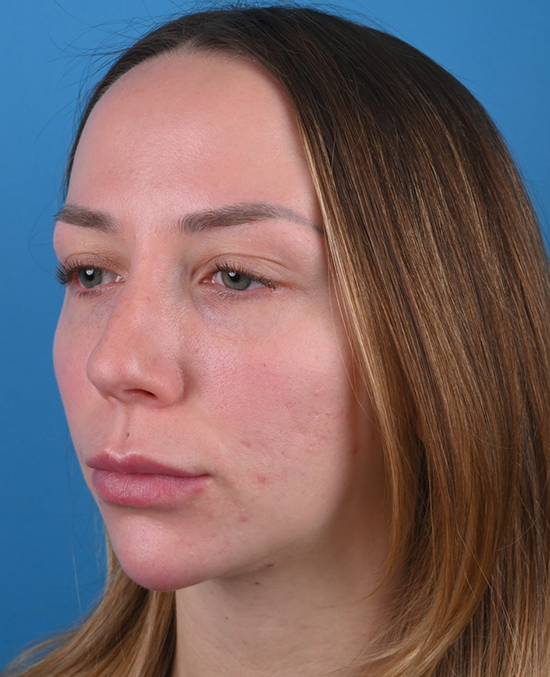 left oblique view before blepharoplasty