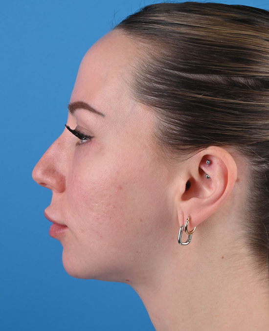 left side view after blepharoplasty