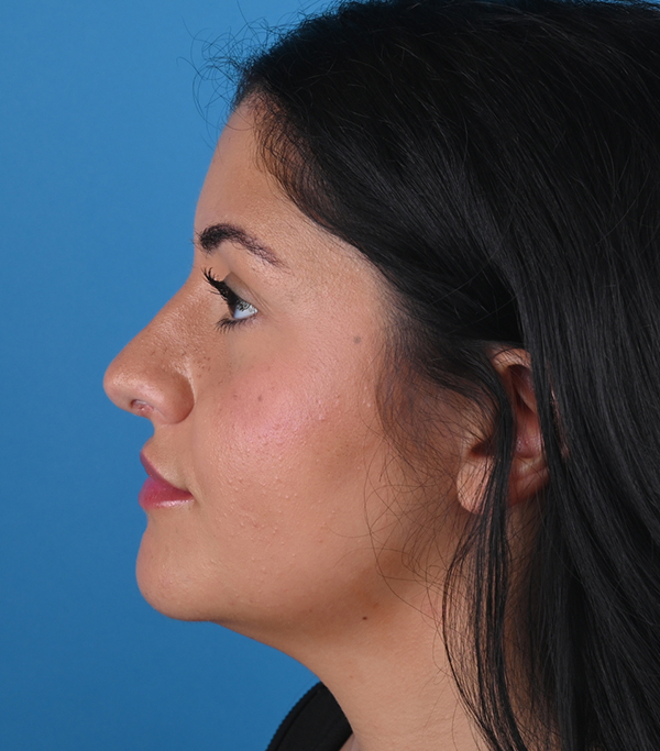left side view after rhinoplasty and genioplasty
