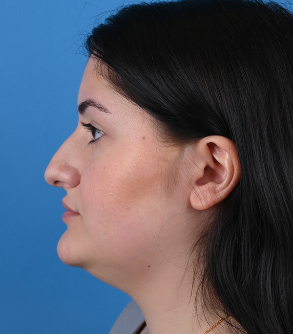 left side view before rhinoplasty and genioplasty