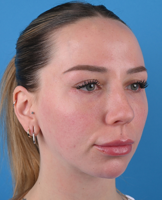 right oblique view after blepharoplasty
