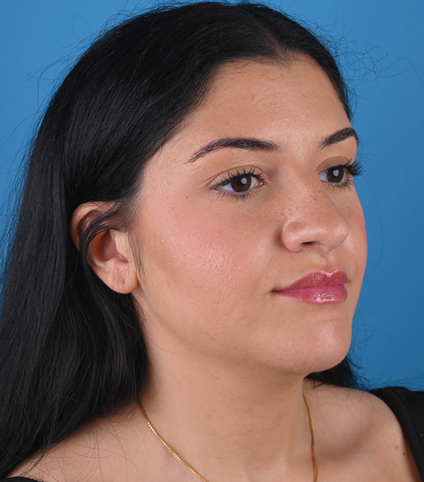right oblique view after rhinoplasty and genioplasty