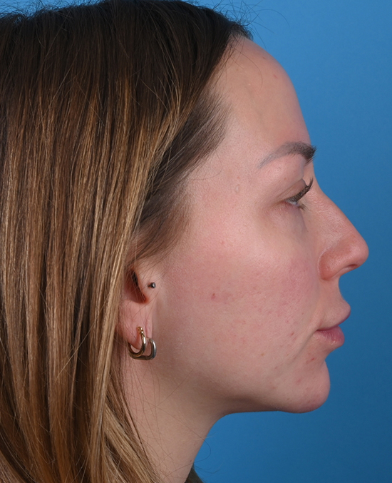 right side view before blepharoplasty