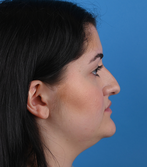 right side view before rhinoplasty and genioplasty