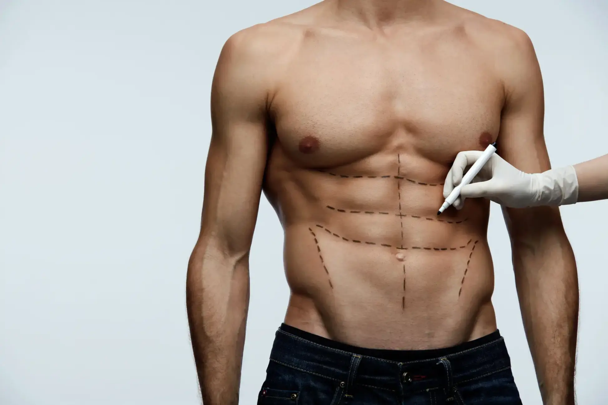 Plastic surgeon marking male torso for body contouring procedure.