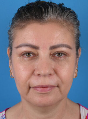 front view after blepharoplasty by Dr. Patel front view after blepharoplasty by Dr. Patel