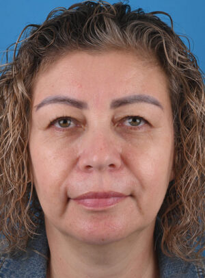 front view before blepharoplasty by Dr. Patel front view before blepharoplasty by Dr. Patel