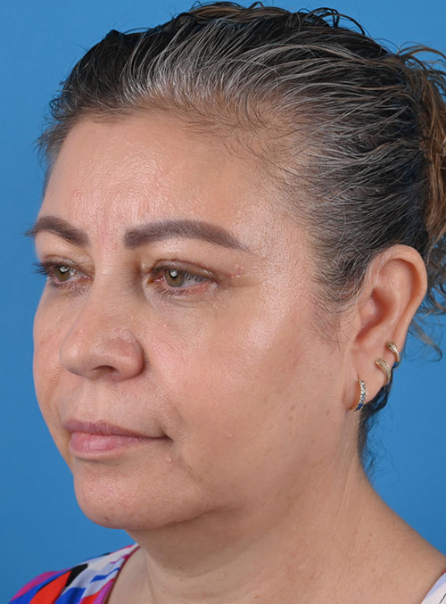 left oblique view after blepharoplasty by Dr. Patel