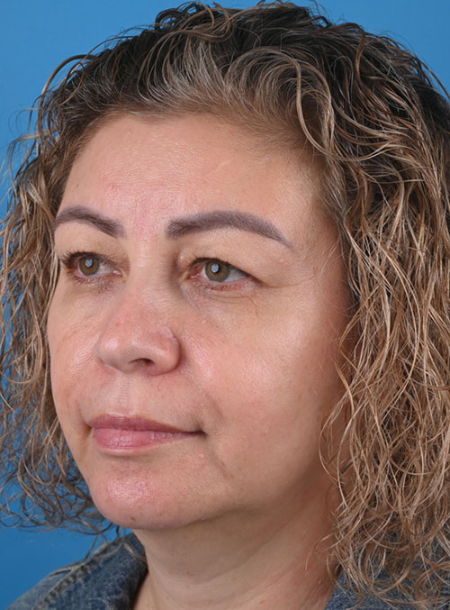 left oblique view before blepharoplasty by Dr. Patel