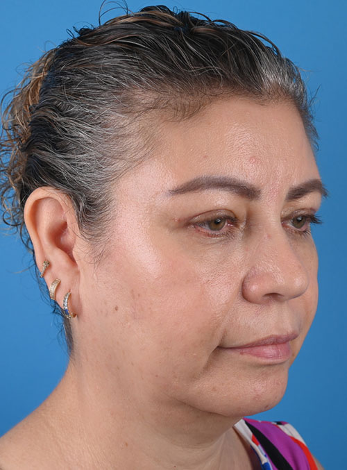 right oblique view after blepharoplasty by Dr. Patel