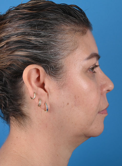 right side view after blepharoplasty by Dr. Patel