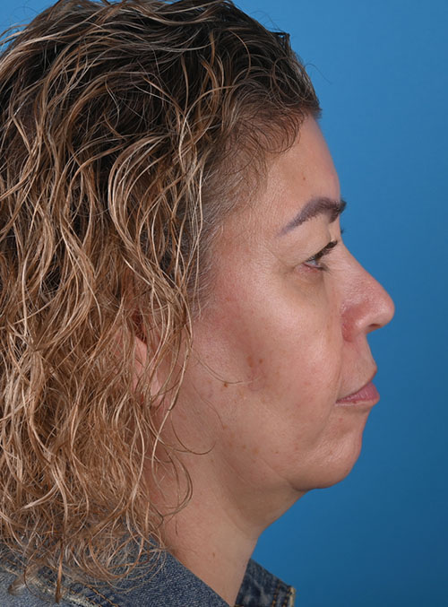 right side view before blepharoplasty by Dr. Patel