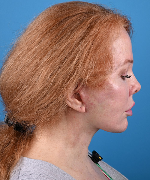 chin down view after face and neck lift by Dr. Patel