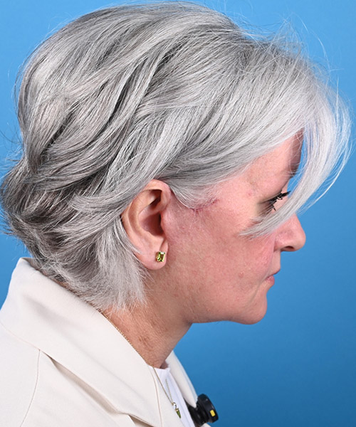 chin down view after face and neck lift by Dr. Patel