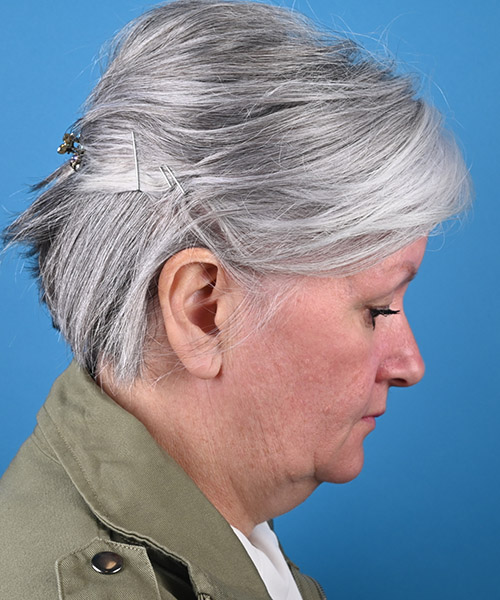 chin down view before face and neck lift by Dr. Patel