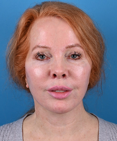 front view after face and neck lift by Dr. Patel