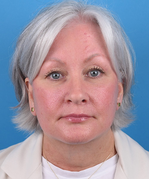 front view after face and neck lift by Dr. Patel