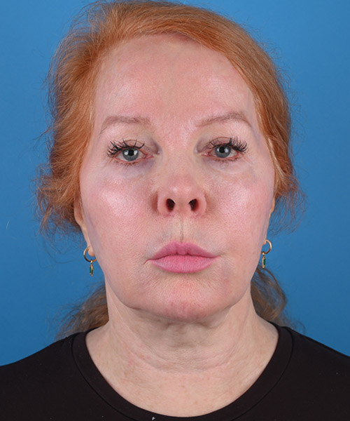 front view before face and neck lift by Dr. Patel