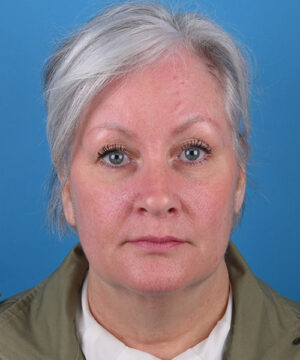 front view before face and neck lift by Dr. Patel front view before face and neck lift by Dr. Patel