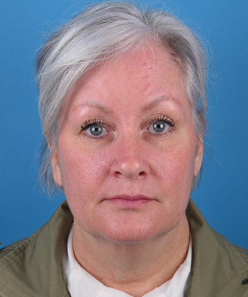 front view before face and neck lift by Dr. Patel