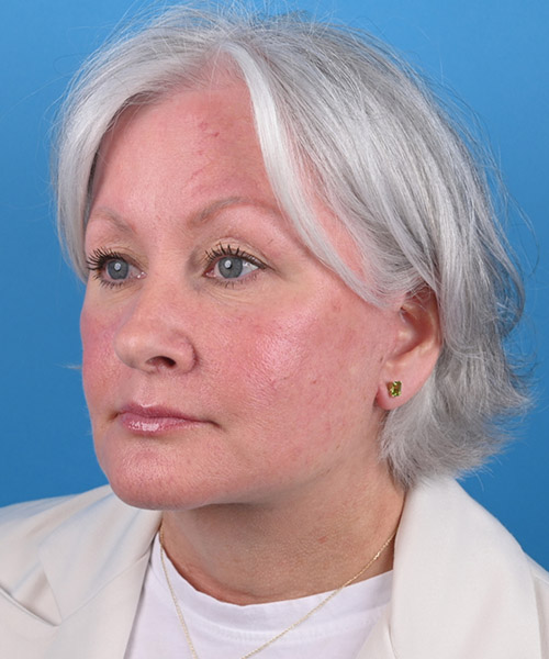 left oblique view after face and neck lift by Dr. Patel