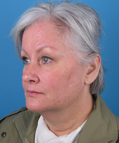 left oblique view before face and neck lift by Dr. Patel
