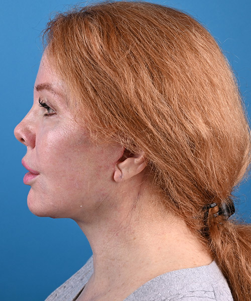 left side view after face and neck lift by Dr. Patel