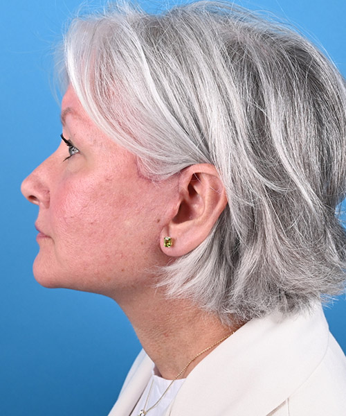 left side view after face and neck lift by Dr. Patel