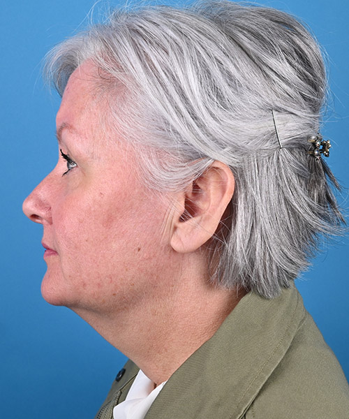 left side view before face and neck lift by Dr. Patel
