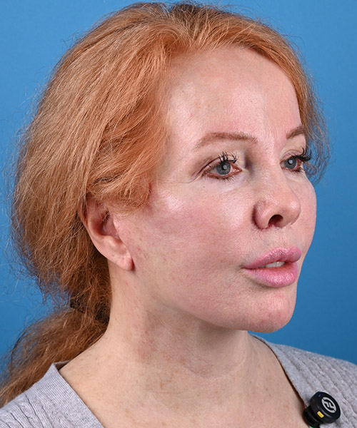 right oblique view after face and neck lift by Dr. Patel
