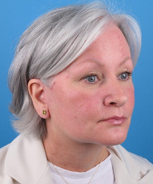 right oblique view after face and neck lift by Dr. Patel