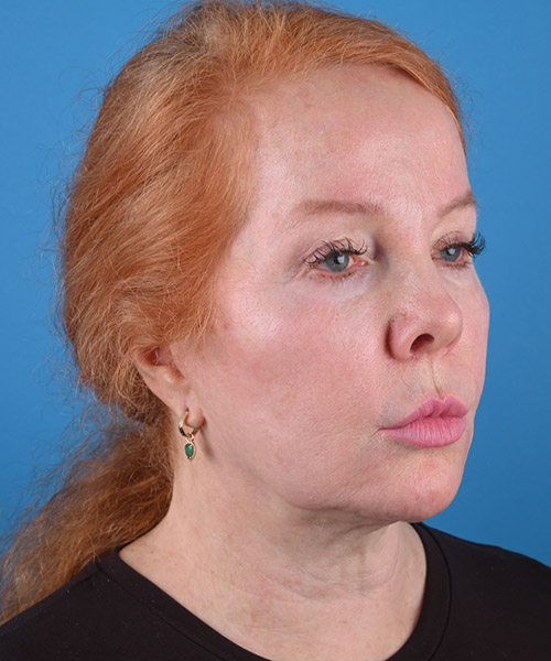 right oblique view before face and neck lift by Dr. Patel