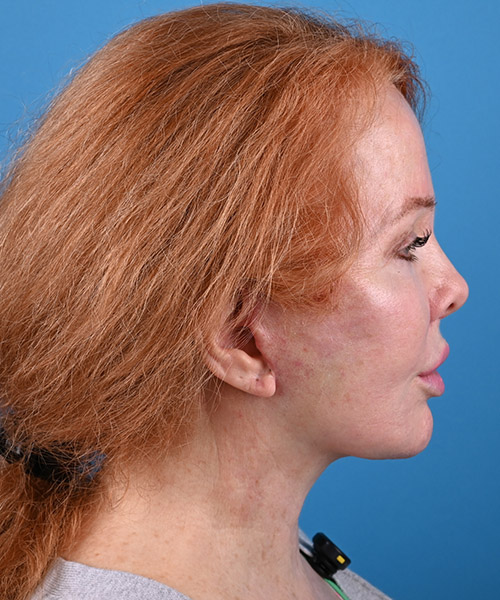 right side view after face and neck lift by Dr. Patel